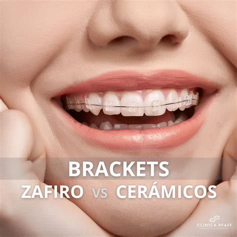 diferencia entre brackets de zafiro y metalicos|cuanto cobran por poner brackets.